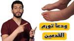 أسباب تورم القدمين وعلاجها