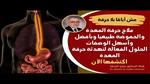أسباب حرقة المعدة وطرق العلاج الفعالة