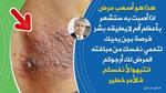 الإرتيكاريا: مرض العصر وطرق التعامل معه