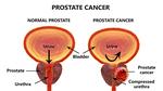 سرطان البروستاتا: الأعراض والعلاج