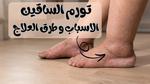 طرق علاج الدوالي وأفضل وسائل الوقاية