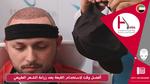 كيفية تجنب الندبات على البشرة بطرق بسيطة
