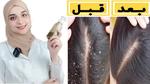 وصفات طبيعية للتخلص من قشرة الرأس
