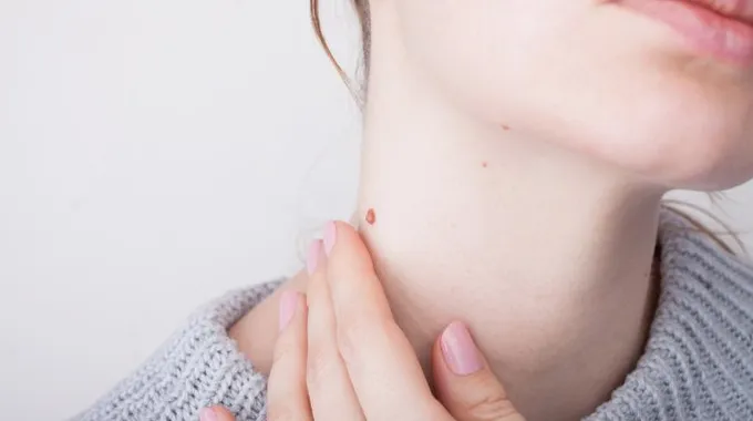 أسباب عين السمكة وأعراضها وطرق علاجها