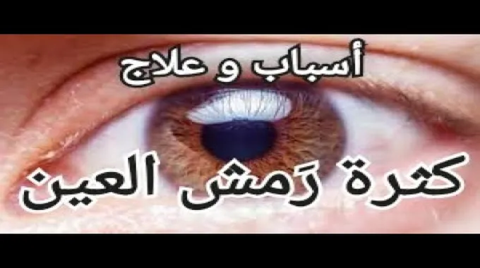 أسباب وعلاج الرمش المفرط