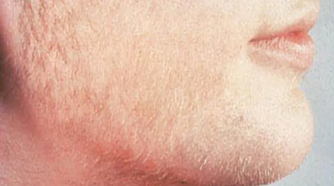 أعراض ارتفاع هرمون الذكورة عند النساء