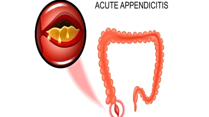 التهاب الزائدة الدودية وأعراضه وعلاجه