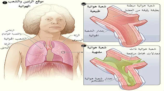 التهاب الشعب الهوائية: الأسباب والأعراض والعلاج