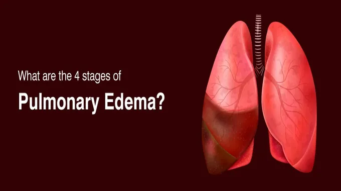 الوذمة الرئوية: الأسباب والعلاج