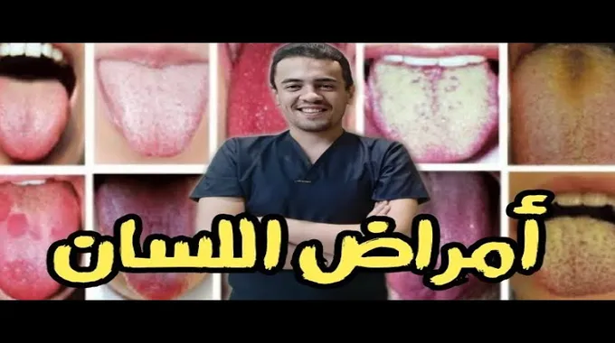 تغير لون اللسان وعلاقته بالصحة