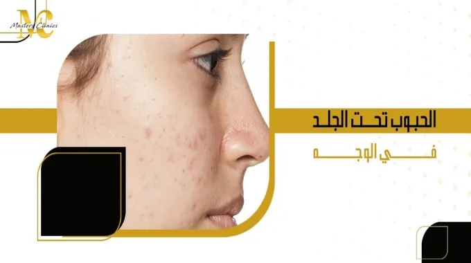 حبوب تحت الجلد: الأسباب والعلاج