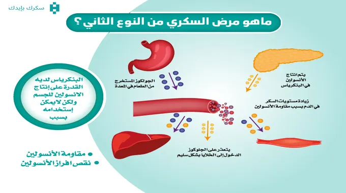 زيادة إصابات مرض السكري من النوع الثاني