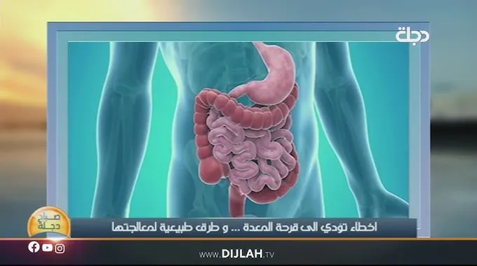 طرق طبيعية لعلاج قرحة المعدة