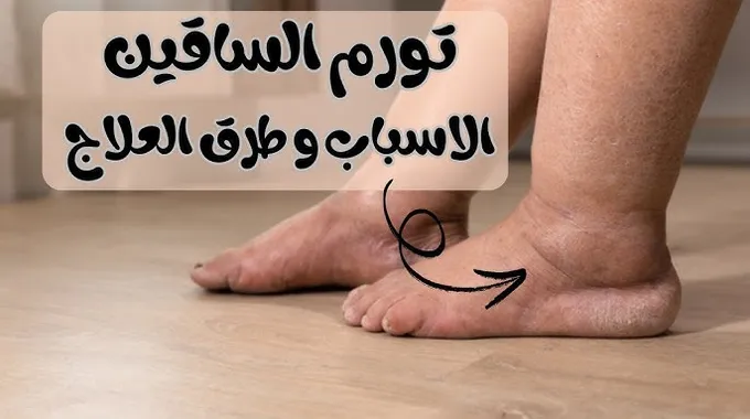 طرق علاج الدوالي وأفضل وسائل الوقاية