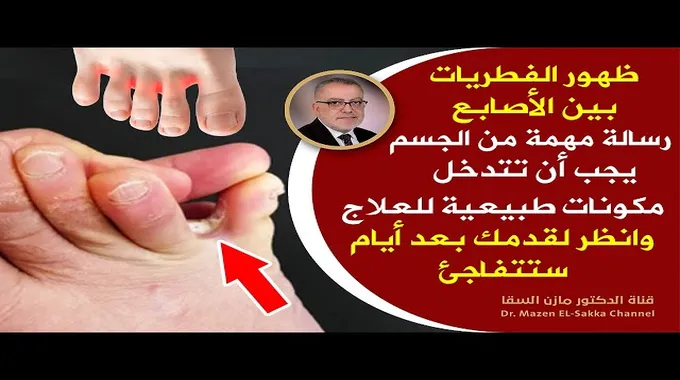 علاج تشقق القدمين بطرق طبيعية فعالة