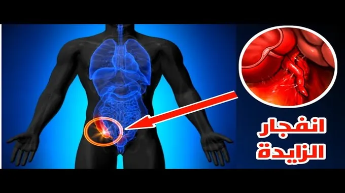 مخاطر انفجار الزائدة الدودية عند الأطفال