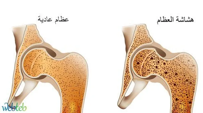 مرض هشاشة العظام: الأعراض والوقاية والعلاج
