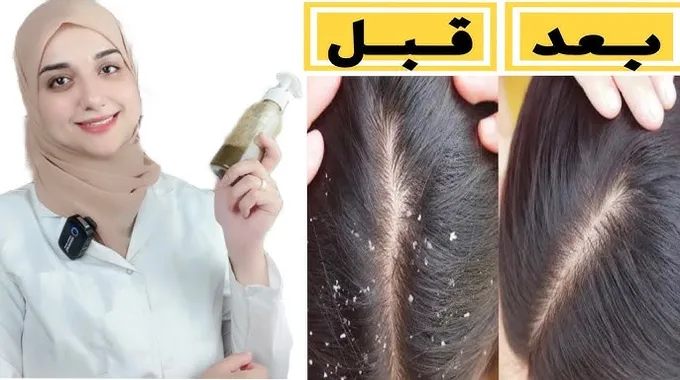 وصفات طبيعية للتخلص من قشرة الرأس
